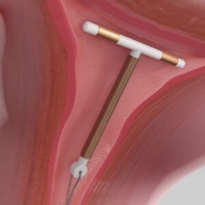 IUD Containing Copper